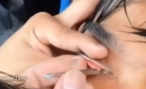 viral mata pria kemasukan lintah ngeri banget sampai diambil pakai pinset