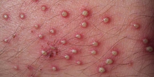 Folikulitis adalah Infeksi pada Folikel Rambut, Kenali Penyebab dan Gejalanya