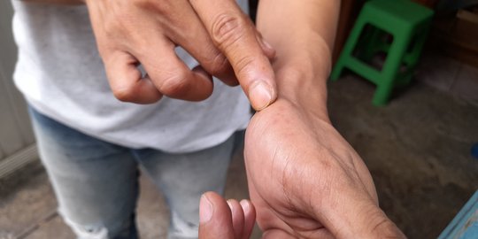 Cerita Warga di Tangsel Digigit King Kobra Sembuh Disuntikkan 'SABU'