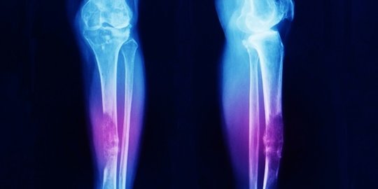 Osteosarcoma adalah Jenis Kanker pada Tulang, Kenali Gejala dan Penyebabnya