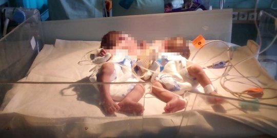 RS Moewardi Solo Berhasil Pisahkan Bayi Kembar Siam Asal Karanganyar, Ini Faktanya
