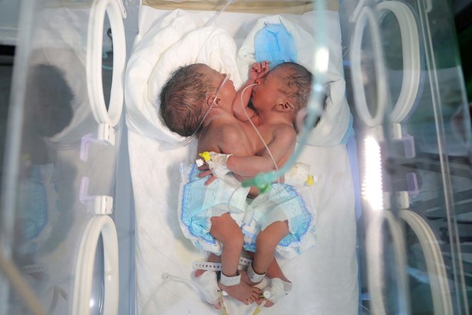 bayi kembar siam di yaman