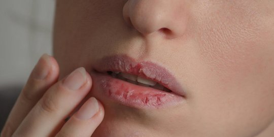 10 Cara Mengatasi Bibir Kering Saat Puasa, Mudah dan Kembalikan Semangat Beribadah