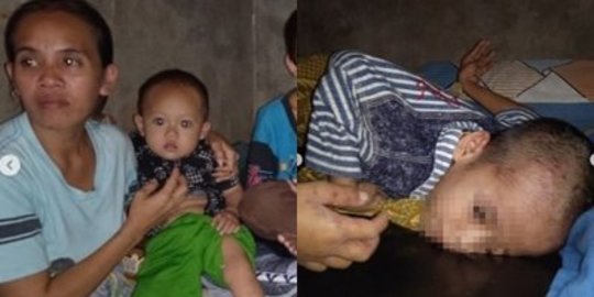 Kisah Miris Wanita Miliki Tiga Anak yang Sakit Kulit, Tak Ada Biaya & Jarang Makan