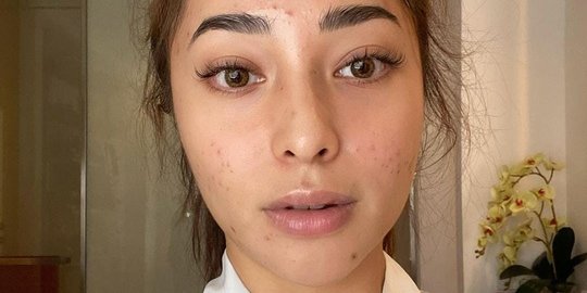 Tak Selalu Mulus, Nikita Willy Beberkan Pengalaman saat Wajah Penuh Jerawat