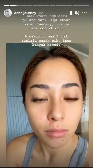 tak selalu mulus nikita willy beberkan pengalaman saat wajah penuh jerawat