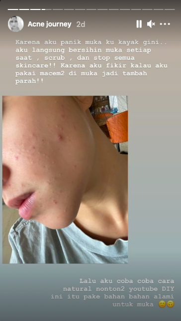 tak selalu mulus nikita willy beberkan pengalaman saat wajah penuh jerawat