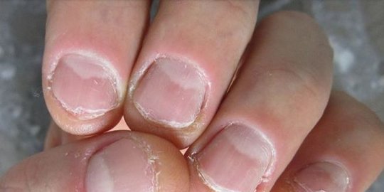 Mengenal Covid Nails, Perubahan Bentuk Kuku Setelah Terinfeksi Virus Corona