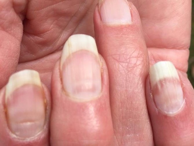 mengenal covid nails perubahan bentuk kuku setelah terinfeksi virus