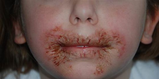9 Penyakit Kulit pada Anak yang Wajib Diketahui Orang Tua, Waspadai