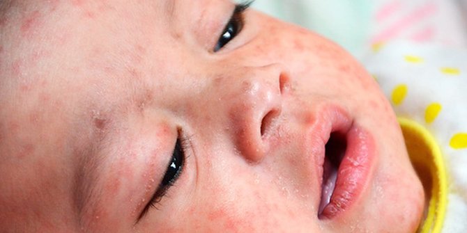 Bahaya Over-Exfoliating: Merusak Kulit Demi Kilau yang Semu dan Cara Menghindarinya