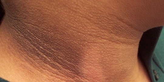 7 Penyebab Leher Hitam yang Sering Diabaikan, Salah Satunya Gejala Diabetes