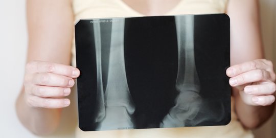 Persiapkan Sejak Usia Muda untuk Mencegah Terjadinya Osteoporosis di Masa Tua