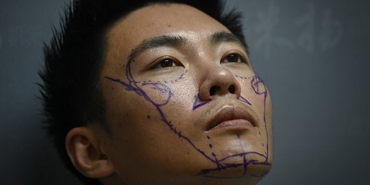 Tren Operasi Plastik Makin Digemari Pria Muda di China