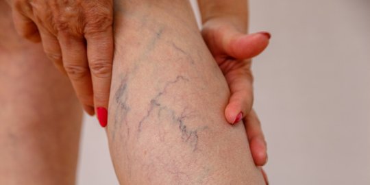Cara Mengatasi Spider Vein dan Pencegahannya, Perlu Diketahui