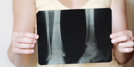Wanita Miliki Risiko Osteoporosis Lebih Tinggi Dibanding Pria
