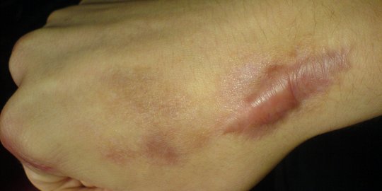 Keloid adalah Bekas Luka yang Tumbuh Secara Abnormal, Ini Penyebabnya