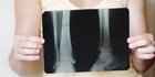 Perempuan Miliki Risiko Osteoporosis 4 Kali Lebih Tinggi Dibanding Laki-Laki