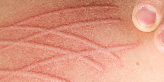 Dermatographia adalah Gangguan Kulit yang Muncul Setelah Digaruk, Ini Gejalanya