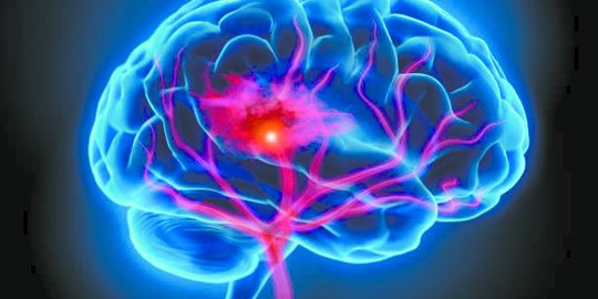 Mengenal Stroke Hemoragik, Kondisi Pecahnya Pembuluh Darah pada Otak