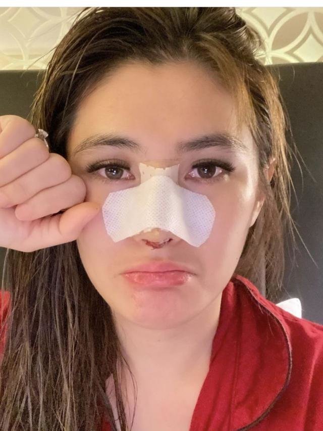 4 potret terbaru angela lee usai operasi hidung akui menyesal