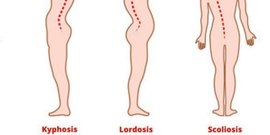 Penyebab Lordosis yang Perlu Diwaspadai, Ketahui Cara Menyembuhkannya