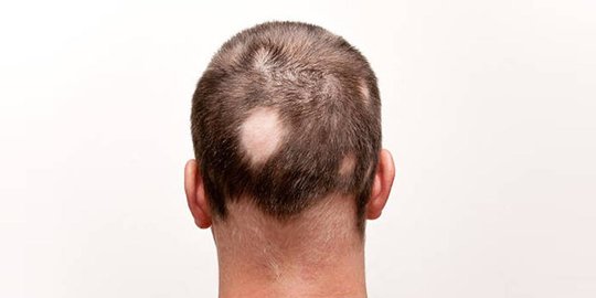 Mengenal Alopecia Areata dan Penyebabnya, Kebotakan Akibat Autoimun