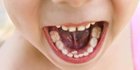 Gejala Erosi Gigi yang Kerap Diabaikan, dari Gigi Sensitif hingga Perubahan Warna