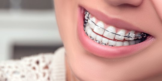 4 Tanda yang Bisa Muncul ketika Kamu Memerlukan Behel pada Gigi