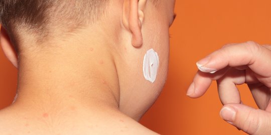 Cara Memudarkan Bekas Cacar dengan Mudah dan Efektif, Gunakan Bahan-bahan Ini