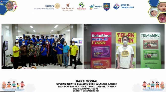 hadirkan senyum untuk anak sido muncul gelar operasi bibir sumbing gratis di tegal