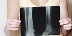 Dianggap Silent Disease, Banyak Kasus Osteoporosis Baru Dikeluhkan saat Tulang Patah