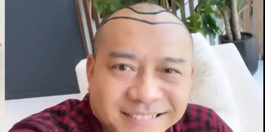 Transplantasi Rambut, Penampilan Baru Anang Hermansyah Ini Disebut Mirip Raul Lemos