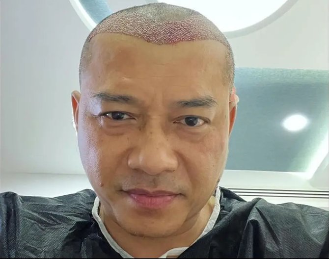 transplantasi rambut penampilan baru anang hermansyah ini disebut mirip raul lemos