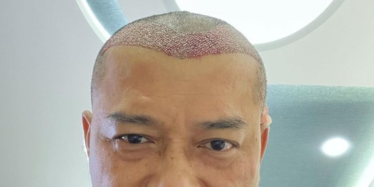 Anang Hermansyah Jalani Transplantasi Rambut, Begini Respons Ashanty