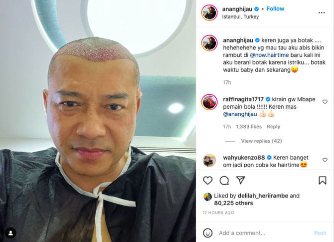 anang hermansyah jalani transplantasi rambut begini respons ashanty
