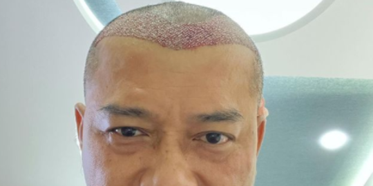 Jalani Transplantasi Rambut, Ini Potret Terbaru Anang Hermansyah Bikin yang Pangling