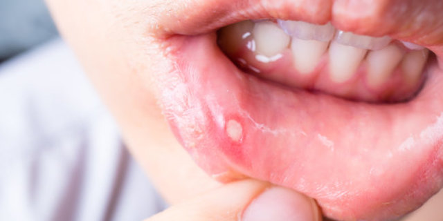 Cara mengatasi mulut tidak ada rasa
