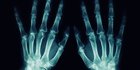 Mengenal Osteopenia: Penyebab, Pencegahan, dan Perbedaannya dengan Osteoporosis