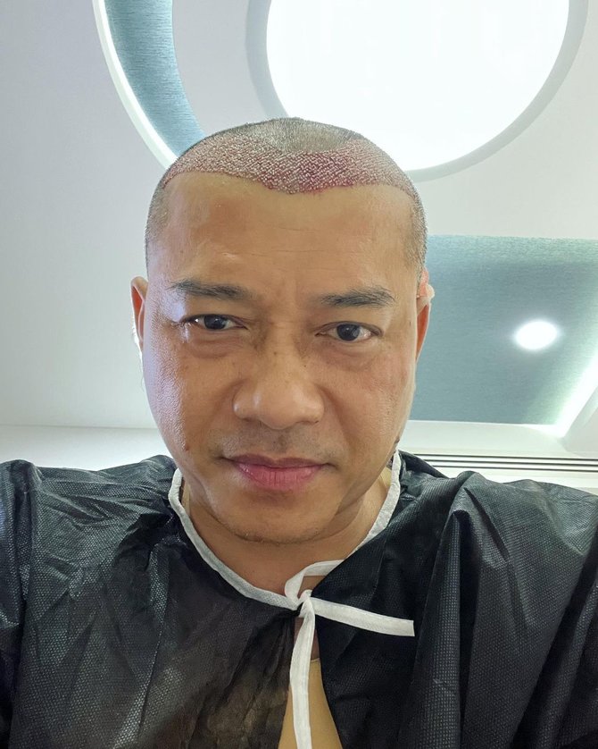 anang hermansyah botak