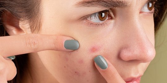 Cara Mengatasi Jerawat saat Haid dengan Bahan Alami, Aman dan Efektif