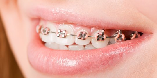 Fakta Kawat Gigi Pada Anak & Ketahui Waktu Pemasangan yang Tepat