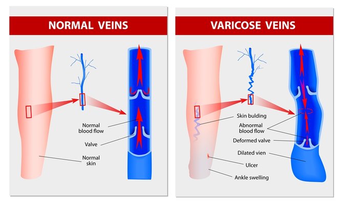 apa itu varises vena ketahui penjelasannya biar tak salah penanganan