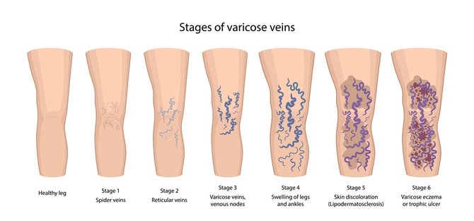 apa itu varises vena ketahui penjelasannya biar tak salah penanganan