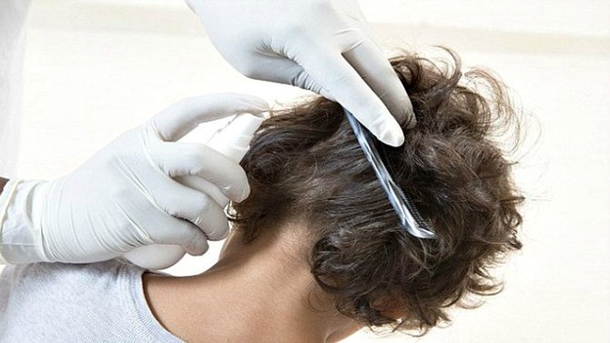 Rambut Rontok di Usia Remaja? Jangan Panik! 12 Tips Ini Bantu Atasi Masalahmu