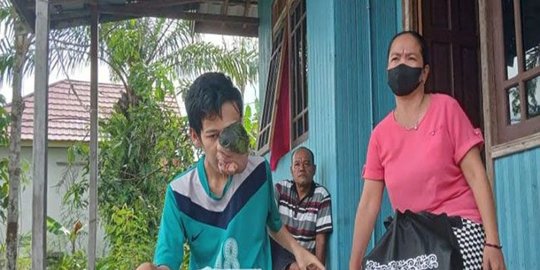 Berawal Benjolan pada Gusi, Seorang Remaja di Palangka Raya Menderita Tumor Wajah