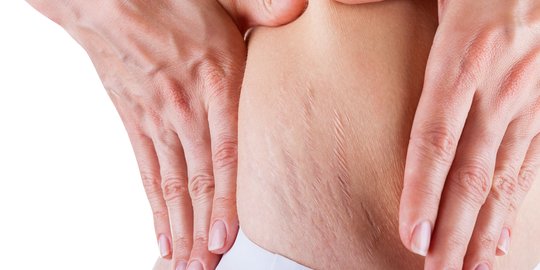 8 Penyebab Stretch Mark di Paha Beserta Cara Mencegahnya, Wanita Harus Tahu