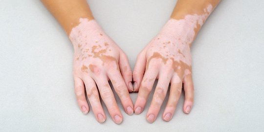 Mengenal Penyakit Vitiligo, Kondisi Kulit yang Kehilangan Warna Alaminya