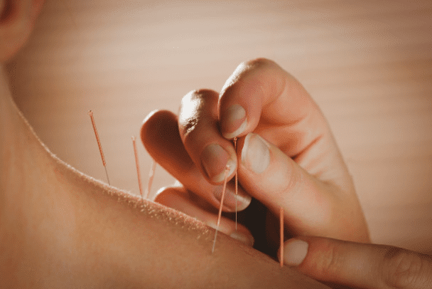 ilustrasi akupuntur