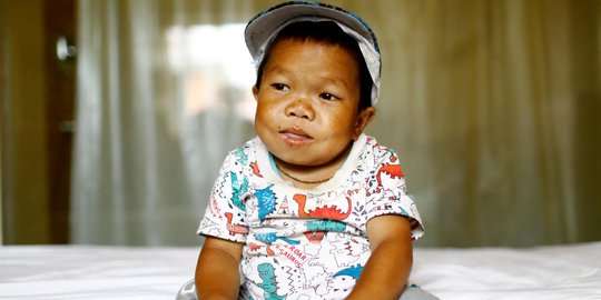 Remaja di Nepal dengan Tubuh Sebesar Bayi 1 Tahun